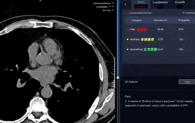 浙江丽水,正在用AI诊癌
